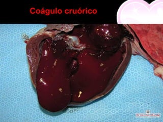 Coágulo cruórico
 