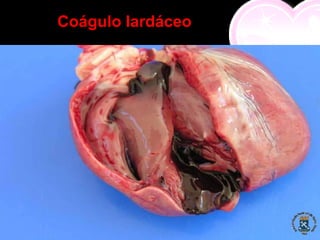Coágulo lardáceo
 