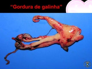 “Gordura de galinha”
 
