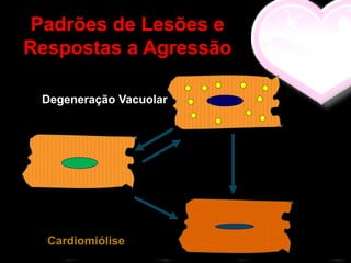 Padrões de Lesões e
Respostas a Agressão

 Degeneração Vacuolar




  Cardiomiólise
 