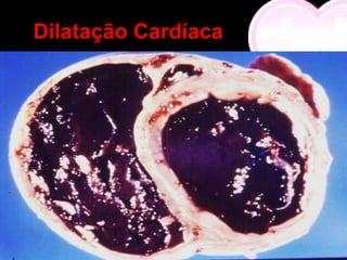Dilatação Cardíaca
 