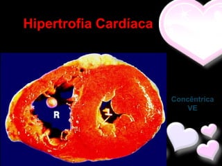Hipertrofia Cardíaca




                       Concêntrica
                           VE
 