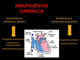 INSUFICIÊNCIA
               CARDÍACA
   Insuficiência                Insuficiência
 ventrículo direito          ventrículo esquerdo




Congestão generalizada            Congestão pulmonar
    Hidrotórax e                    Edema pulmonar
   hidropericárdio
Hidroperitôneo (ascite)
 