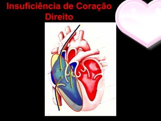 Insuficiência de Coração
         Direito
 