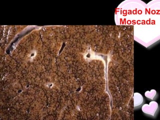 Fígado Noz
 Moscada
 