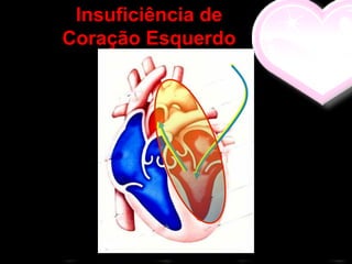 Insuficiência de
Coração Esquerdo
 