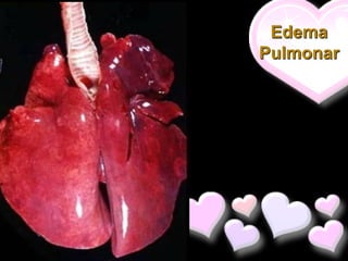 Edema
Pulmonar
 