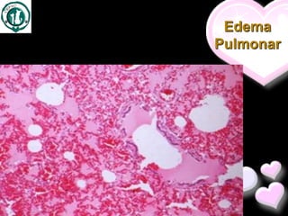 Edema
Pulmonar
 
