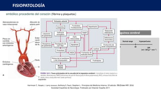 embólico procedente del corazón (fibrina y plaquetas)
FISIOPATOLOGÍA
Perfusión sanguinea cerebral
Sociedad Española de Neurología. Publicado por Elsevier España 2011
Harrinson T, Kasper, J. Larry Jameson, Anthony S. Fauci, Stephen L. Principios de Medicina Interna. 19 edición. McGraw-Hill. 2016
 
