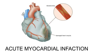 ACUTE MYOCARDIAL INFACTION
 