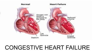 CONGESTIVE HEART FAILURE
 