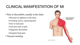 CLINICAL MANIFESTATION OF MI
• Pain or discomfort, usually in the chest
Pressure or tightness in the chest
Crushing ,heavy, squeezing pain
Jaw or neck pain
Left arm ache or pain
Epigastric discomfort
Scapular back pain
• Nausea/vomiting
 