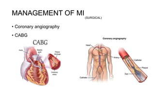 • Coronary angiography
• CABG
MANAGEMENT OF MI(SURGICAL)
 