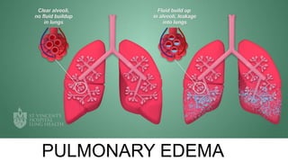 PULMONARY EDEMA
 