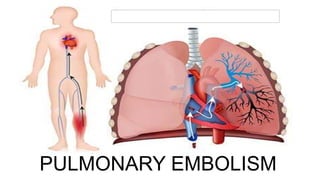 PULMONARY EMBOLISM
 