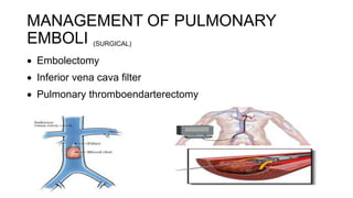 MANAGEMENT OF PULMONARY
EMBOLI (SURGICAL)
 Embolectomy
 Inferior vena cava filter
 Pulmonary thromboendarterectomy
 