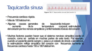 • Frecuenciacardíaca rápida.
• Másde100latidos/min.
• Algunas causas generales de taquicardia incluyen
aumento dela temperatura corporal, estimulación
delcorazónporlosnerviossimpáticosyenfermedadestóxicasdelcorazón.
• Muchos factores pueden hacer que el sistema nervioso simpático excite el
corazón, como se señala en muchas partes de este texto. Por ejemplo,
cuandounpacientepierdesangrey pasaaunestadodeshockosemishock,
la estimulación refleja simpática del corazón con frecuencia aumenta la
frecuenciacardíacahasta150a1801atidos/min.
Taquicardia sinusal
 