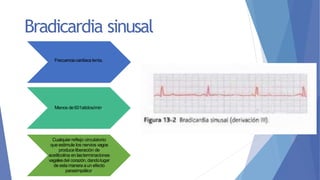 Bradicardia sinusal
Frecuenciacardíaca lenta.
Menos de601atidos/min.
Cualquier reflejo circulatorio
que estimule los nervios vagos
produce liberación de
acetilcolina en lasterminaciones
vagalesdel corazón,dandolugar
de estamanera aun efecto
parasimpático.
 