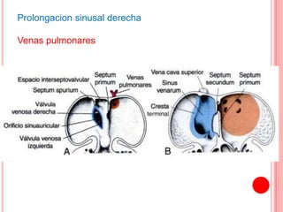 Prolongacion sinusal derecha
Venas pulmonares
 