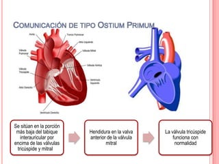Se sitúan en la porción
más baja del tabique
interauricular por
encima de las válvulas
tricúspide y mitral
Hendidura en la valva
anterior de la válvula
mitral
La válvula tricúspide
funciona con
normalidad
COMUNICACIÓN DE TIPO OSTIUM PRIMUM
 