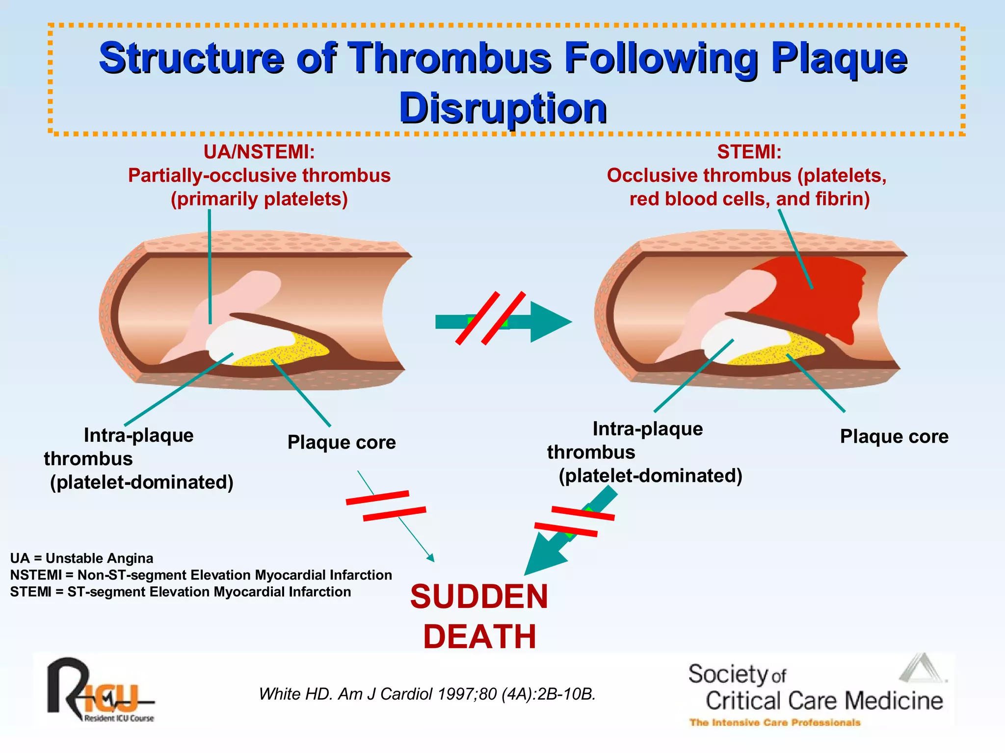 UA/NSTEMI: Partially-occlusive thrombus (primarily platelets) Intra-plaque  thrombus  (platelet-dominated) Plaque core STEMI: Occlusive thrombus (platelets,  red blood cells, and fibrin) Intra-plaque  thrombus  (platelet-dominated) Plaque core SUDDEN DEATH UA = Unstable Angina NSTEMI = Non-ST-segment Elevation Myocardial Infarction STEMI = ST-segment Elevation Myocardial Infarction Structure of Thrombus Following Plaque Disruption White HD. Am J Cardiol 1997;80 (4A):2B-10B. 