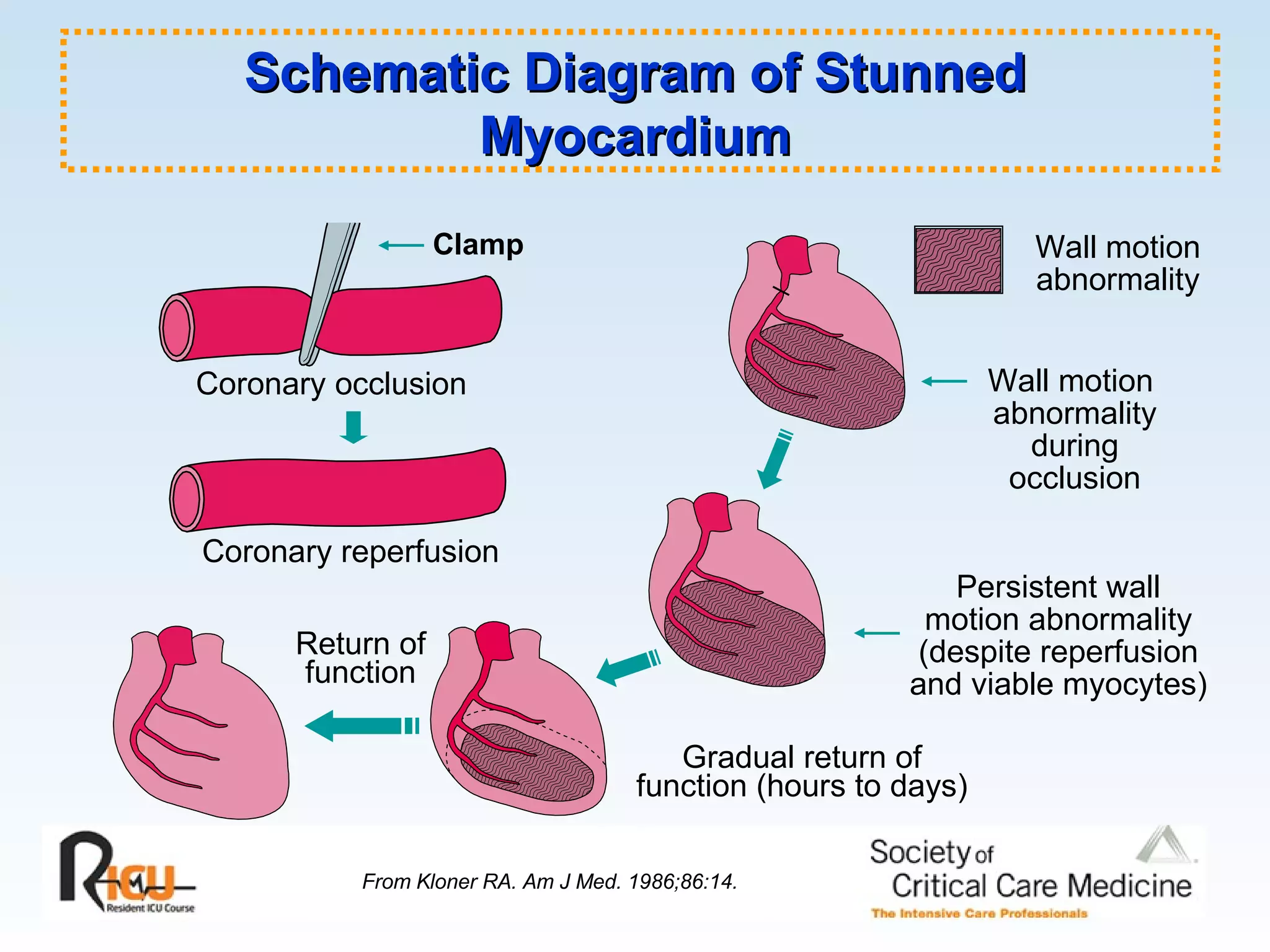 Wall motion  abnormality during occlusion Wall motion abnormality From Kloner RA. Am J Med. 1986;86:14. Gradual return of function (hours to days) Persistent wall motion abnormality (despite reperfusion and viable myocytes) Coronary occlusion Coronary reperfusion Return of function Clamp Schematic Diagram of Stunned Myocardium 