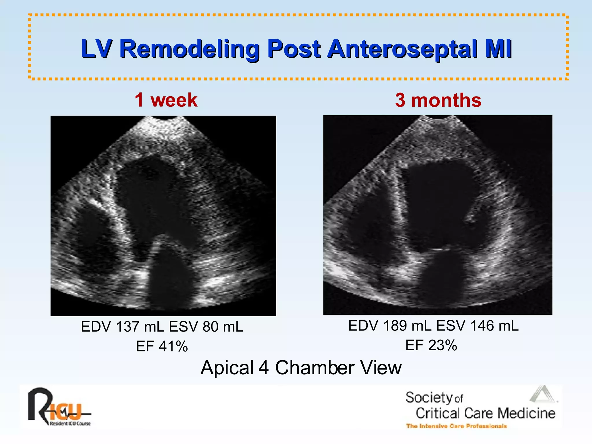 LV Remodeling Post Anteroseptal MI 1 week 3 months EDV 137 mL ESV 80 mL EF 41% EDV 189 mL ESV 146 mL EF 23% Apical 4 Chamber View 