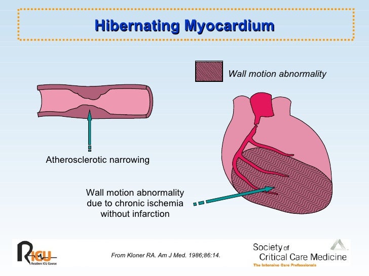 Cardiogenic Shock