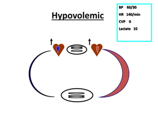 Hypovolemic
BP 60/30
HR 140/min
CVP 0
Lactate 10
 