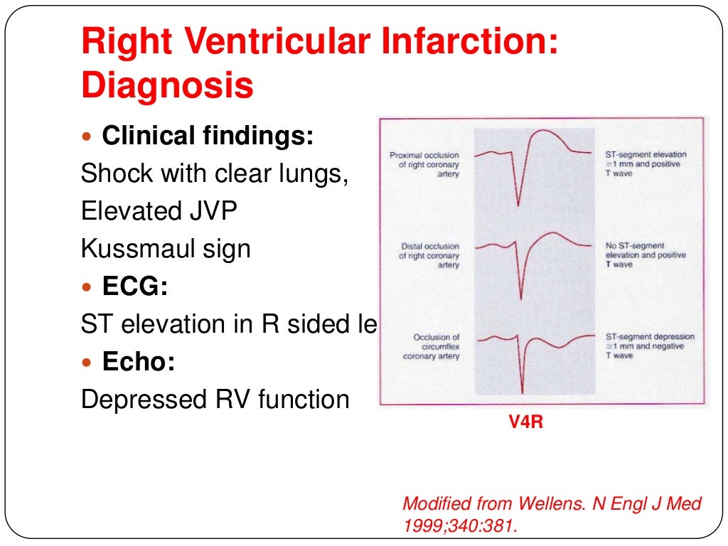 Cardiogenic shock dr awadhesh