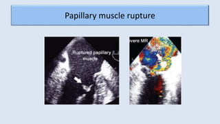 Cardiogenic shock following acute MI | PPTX