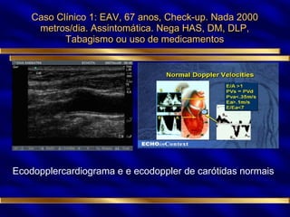 Caso Clínico 1: EAV, 67 anos, Check-up. Nada 2000 metros/dia. Assintomática. Nega HAS, DM, DLP, Tabagismo ou uso de medicamentos Ecodopplercardiograma e e ecodoppler de carótidas normais 