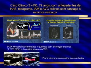 Caso Clínico 3 – FC, 79 anos, com antecedentes de HAS, tabagismo, IAM e AVC prévios com cansaço a mínimos esforços  ECO: Miocardiopatia dilatada isquêmica com disfunção sistólica  ( FEVE 30%) e diastólica severa do V.E. Placa ulcerada na carótida interna direita 