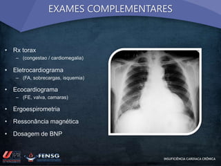 EXAMES COMPLEMENTARES 
• Rx torax 
– (congestao / cardiomegalia) 
• Eletrocardiograma 
– (FA, sobrecargas, isquemia) 
• Ecocardiograma 
– (FE, valva, camaras) 
• Ergoespirometria 
• Ressonância magnética 
• Dosagem de BNP 
INSUFICIÊNCIA CARDÍACA CRÔNICA 
 