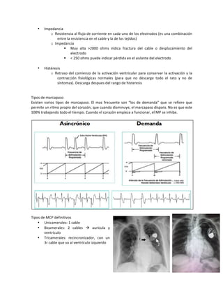 • Impedancia!
o Resistencia!al!flujo!de!corriente!en!cada!uno!de!los!electrodos!(es!una!combinación!
entre!la!resistencia!en!el!cable!y!la!de!los!tejidos)!
o Impedancia!
! Muy! alta! >2000! ohms! indica! fractura! del! cable! o! desplazamiento! del!
electrodo!
! <!250!ohms!puede!indicar!pérdida!en!el!aislante!del!electrodo!
!
• Histéresis!
o Retraso!del!comienzo!de!la!activación!ventricular!para!conservar!la!activación!y!la!
contracción! fisiológicas! normales! (para! que! no! descarge! todo! el! rato! y! no! de!
sintomas).!Descarga!despues!del!rango!de!histeresis!
!
!
Tipos!de!marcapaso!
Existen! varios! tipos! de! marcapaso.! El! mas! frecuente! son! “los! de! demanda”! que! se! refiere! que!
permite!un!ritmo!propio!del!corazón,!que!cuando!disminuye,!el!marcapaso!dispara.!No!es!que!este!
100%!trabajando!todo!el!tiempo.!Cuando!el!corazón!empieza!a!funcionar,!el!MP!se!inhibe.!
!
!
!
Tipos!de!MCP!definitivos!
• Unicamerales:!1!cable!
• Bicamerales:! 2! cables! "! aurícula! y!
ventrículo!
• Tricamerales:! recincronizador,! con! un!
3r!cable!que!va!al!ventrículo!izquierdo!
!
!
!
 