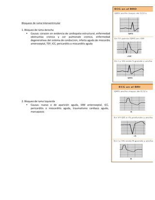 !
Bloqueos!de!rama!Interventricular!
!
1.!Bloqueo!de!rama!derecha!
• Causas:!corazon!sin!evidencia!de!cardiopatia!estructural,!enfermedad!
obstructiva! cronica! y! cor! pulmonale! cronico,! enfermedad!
degenerativas!del!sistema!de!conduccion,!infarto!agudo!de!miocardio!
anteroseptal,!TEP,!ICC,!pericarditis!o!miocarditis!aguda!
!
!
!
!
!
!
!
!
!
!
!
!
!
!
!
!
2.!Bloqueo!de!rama!Izquierda!
• Causas:! nuevo! o! de! aparición! aguda,! IAM! anteroseptal,! ICC,!
pericarditis! o! miocarditis! aguda,! traumatismo! cardiaco! agudo,!
marcapasos!!
 