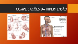 COMPLICAÇÕES DA HIPERTENSÃO
 