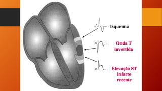 Onda T
invertida
Elevação ST
infarto
recente
 