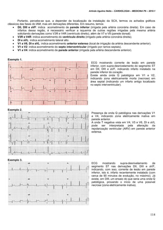 Arlindo Ugulino Netto – CARDIOLOGIA – MEDICINA P6 – 2010.1
114
Portanto, percebe-se que, a depender da localização da instalação da SCA, termos os achados gráficos
clássicos das fases do IAM, mas em derivações diferentes. Em resumo, temos:
 DII, DIII e aVF: indica acometimento de parede inferior (irrigada pela artéria coronária direita). Em caso de
infartos dessa região, é necessário verificar a isquemia de outras regiões irrigadas pela mesma artéria
solicitando derivações como V3R e V4R (ventrículo direito), além de V7 e V8 (parede dorsal).
 V3R e V4R: indica acometimento do ventrículo direito (irrigado pela artéria coronária direita).
 DI e aVL: indica acometimento lateral alto.
 V1 a V6, DI e aVL: indica acometimento anterior extenso (local de irrigação da artéria descendente anterior).
 V1 e V2: indica acometimento do septo interventricular (irrigado por ramos septais).
 V1 a V4: indica acometimento de parede anterior (irrigada pela artéria descendente anterior).
Exemplo 1.
ECG mostrando corrente de lesão em parede
inferior, com supra-desnivelamento do segmento ST
em DII, DIII e aVF, indicando infarto instalado na
parede inferior do coração.
Existe ainda onda Q patológica em V1 e V2,
indicando zona eletricamente morta (necrose) em
área septal (indicando um infarto antigo localizado
no septo interventricular).
Exemplo 2.
Presença de onda Q patológica nas derivações V1
a V4, indicando zona eletricamente inativa em
parede anterior.
A onda T negativa vista em V4, V5 e V6, DI e aVL
pode ser interpretada pela alteração da
repolarização ventricular (ARV) em parede anterior
extensa.
Exemplo 3.
ECG mostrando supra-desnivelamento de
segmento ST nas derivações DII, DIII e aVF,
indicando, com isso, corrente de lesão em parede
inferior, isto é, infarto recentemente instalado (com
cerca de 90 minutos de evolução, no máximo). Já
existe, em DIII, um ensaio do que seria uma onda Q
patológica, provando o início de uma possível
necrose (zona eletricamente inativa).
 