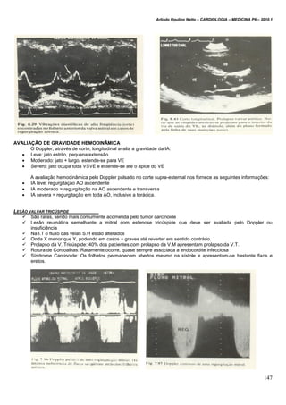 Arlindo Ugulino Netto – CARDIOLOGIA – MEDICINA P6 – 2010.1
147
AVALIAÇÃO DE GRAVIDADE HEMODINÂMICA
O Doppler, através de corte, longitudinal avalia a gravidade da IA:
 Leve: jato estrito, pequena extensão
 Moderado: jato + largo, estende-se para VE
 Severo: jato ocupa toda VSVE e estende-se até o ápice do VE
A avaliação hemodinâmica pelo Doppler pulsado no corte supra-esternal nos fornece as seguintes informações:
 IA leve: regurgitação AO ascendente
 IA moderado = regurgitação na AO ascendente e transversa
 IA severa = regurgitação em toda AO, inclusive a torácica.
LESÃO VALVAR TRICÚSPIDE
 São raras, sendo mais comumente acometida pelo tumor carcinoide
 Lesão reumática semelhante a mitral com estenose tricúspide que deve ser avaliada pelo Doppler ou
insuficiência
 Na I.T o fluxo das veias S.H estão alterados
 Onda X menor que Y, podendo em casos + graves até reverter em sentido contrário.
 Prolapso da V. Tricúspide: 40% dos pacientes com prolapso da V.M apresentam prolapso da V.T.
 Rotura de Cordoalhas: Raramente ocorre, quase sempre associada a endocordite infecciosa
 Síndrome Carcinoide: Os folhetos permanecem abertos mesmo na sístole e apresentam-se bastante fixos e
eretos.
 