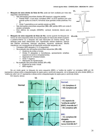 Arlindo Ugulino Netto – CARDIOLOGIA – MEDICINA P6 – 2010.1
28
 Bloqueio de ramo direito do feixe de His: pode ser bem avaliado por meio das
seguintes características:
o Nas derivações precordiais direitas (V1) teremos o seguinte padrão:
 Padrão RSR’: o que seria “complexo QRS” no ECG aparece com uma
grande quilha na onda R, formando duas grandes ondas positivas: R e
R’.
 Onda T assimétrica e em sentido oposto ao QRS.
o Nas derivações precordiais esquerdas (V6) e DI: padrão QRS com onda S
ampla e arrastada.
o Eixo elétrico do coração (SÂQRS): variável, tendendo desvio para a
direita.
 Bloqueio de ramo esquerdo do feixe de His: ocorre quando há bloqueio do
tronco do ramo esquerdo antes da sua bifurcação em fascículos ântero-superior
e póstero-inferior ou o bloqueio dos dois fascículos ao mesmo tempo. Sua
etiologia pode estar relacionada com: hipertensão arterial sistêmica, doença
das artérias coronárias, doenças valvulares, isquemia, esclerose, fatores
mecânicos, em consequência da hipertrofia ventricular esquerda, etc.
o Complexo QRS alargado (> 0,12 segundos).
o Na avaliação das derivações precordiais esquerdas (V5 e V6):
 Ausência de ondas q iniciais.
 Ondas R alargadas e monofásicas, apresentando entalhes
(aspecto em torre) e empastamentos.
 Segmento ST infradesnivelado.
 Onda T negativa.
 Alterações da repolarização.
o Na avaliação das precordiais direitas (V1 e V2):
 Ausência da onda r inicial.
 QRS negativo.
De um modo geral, no bloqueio de ramo esquerdo (BRE), a “orelha de coelho” no complexo QRS em V6
representa o atraso entre a despolarização do septo para o ventrículo esquerdo. Já no bloqueio de ramo direito (BRD), a
“orelha de colho” em V1 representa o atraso entre a despolarização do septo para o ventrículo direito.
Em resumo, temos:
 