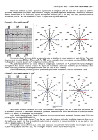 Arlindo Ugulino Netto – CARDIOLOGIA – MEDICINA P6 – 2010.1
36
Depois de realizado o passo 1 (observar a polaridade do complexo QRS em DI e aVF) e o passo 2 (definir o
quadrante onde estará localizado o eixo elétrico do coração), devemos especificar ainda mais a localização deste eixo
elétrico, identificando a sua localização a partir de intervalos menores (de 30 em 30º). Para isso, devemos continuar
através dos passos 3, 4 e, se necessário, o passo 5. Vejamos os seguintes exemplos:
Exemplo
2
– Eixo elétrico em 0
o
.
Em primeiro lugar, devemos definir o quadrante onde se localiza, de modo grosseiro, o eixo elétrico. Para isso,
observamos o complexo QRS em DI e em aVF. No ECG acima mostrado, observamos que o complexo QRS em DI está
muito positivo, enquanto que em aVF, está praticamente isoelétrico.
Daí, podemos determinar que o eixo elétrico do coração está exatamente em 0
o
, praticamente representado pela
derivação DI. Isso porque segundo o “passo 4”, depois de encontrada a derivação isoelétrica (ou isodifásica), o eixo
estará localizado justamente no vetor perpendicular a ele (no caso de aVF, será DI).
Indivíduos obesos e pacientes grávidas geralmente apresentam eixo elétrico cardíaco semelhante a este.
Exemplo
3
– Eixo elétrico entre 0
o
e 30
o
.
No primeiro momento, devemos procurar o comportamento do complexo QRS em DI e em aVF. Em ambos, ele
se apresenta positivo e, a partir desta informação, podemos determinar que o eixo se encontra no quadrante inferior
direito (com relação ao observador, evidentemente).
Logo depois, obedecendo ao “passo 3”, devemos procurar uma derivação isoelétrica. Contudo, neste ECG, não
existe nenhum complexo QRS isoelétrico.
Passamos então para o “passo 5” que diz que caso não haja uma derivação isoelétrica, devemos observar as
derivações que cruzam por fora do quadrante determinado e selecionar o eixo perpendicular a ele que estiver mais
próximo da polaridade de DI ou aVF.
No exemplo, como definimos que o eixo está localizado no quadrante inferior direito, as derivações que não
cruzam este quadrante são: DIII e aVL. Por convenção, devemos sempre iniciar observando DIII.
 