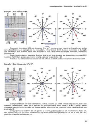 Arlindo Ugulino Netto – CARDIOLOGIA – MEDICINA P6 – 2010.1
38
Exemplo
6
– Eixo elétrico em 60º.
Observando o complexo QRS nas derivações D1 e aVF, percebe-se que, mesmo sendo positivo em ambas
derivações (determinando a posição do eixo no quadrante inferior direito), devido à grande positividade da derivação
aVF com relação à DI, podemos prever parte da conclusão final: o eixo elétrico do coração, neste caso, estará mais
próximo à aVF.
Depois de determinado o quadrante, devemos observar por uma derivação que apresente um complexo QRS
isoelétrico. No ECG em questão, observamos em aVL, cujo vetor perpendicular é DII.
Portanto, o eixo elétrico cardíaco coincide com DII, estando localizado em 60
o
, mais próximo de aVF do que DI.
Exemplo
7
– Eixo elétrico entre 60º e 90º.
O complexo QRS em aVF está extremamente positivo, enquanto que em DI, embora esteja positivo, está quase
isoelétrico. Determinamos, assim, que o eixo está no quadrante inferior direito (entre 0
o
e 90º). Contudo, apenas
observando a amplitude dos complexos nas duas derivações, veremos, ao final, que o eixo cardíaco está localizado bem
próximo à aVF.
Como podemos ver no ECG, DIII está positivo e, portanto, podemos observar aVL imediatamente. Como aVL
está negativo, conclui-se que o eixo está localizado logo abaixo de seu vetor perpendicular DII, isto é: entre 60º e 90º,
justificando sua maior proximidade à aVF.
 