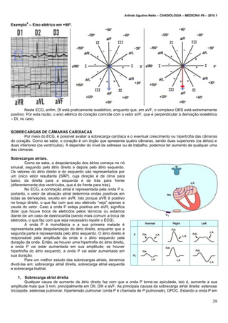 Arlindo Ugulino Netto – CARDIOLOGIA – MEDICINA P6 – 2010.1
39
Exemplo
8
– Eixo elétrico em +90º.
Neste ECG, enfim, DI está praticamente isoelétrico, enquanto que, em aVF, o complexo QRS está extremamente
positivo. Por esta razão, o eixo elétrico do coração coincide com o vetor aVF, que é perpendicular à derivação isoelétrica
– DI, no caso.
SOBRECARGAS DE CÂMARAS CARDÍACAS
Por meio do ECG, é possível avaliar a sobrecarga cardíaca e o eventual crescimento ou hipertrofia das câmaras
do coração. Como se sabe, o coração é um órgão que apresenta quatro câmaras, sendo duas superiores (os átrios) e
duas inferiores (os ventrículos). A depender do nível de estresse ou de trabalho, podemos ter aumento de qualquer uma
das câmaras.
Sobrecargas atriais.
Como se sabe, a despolarização dos átrios começa no nó
sinusal, seguindo pelo átrio direito e depois pelo átrio esquerdo.
Os vetores do átrio direito e do esquerdo são representados por
um único vetor resultante (SÂP), cuja direção é de cima para
baixo, da direita para a esquerda e de trás para frente
(diferentemente dos ventrículos, que é de frente para trás).
No ECG, a contração atrial é representada pela onda P e,
portanto, o vetor de ativação atrial determina ondas positivas em
todas as derivações, exceto em aVR. Isto porque aVR é positivo
no braço direito, o que faz com que seu eletrodo “veja” apenas a
cauda do vetor. Caso a onda P esteja positiva em aVR, significa
dizer que houve troca de eletrodos pelos técnicos ou estamos
diante de um caso de dextrocardia (sendo mais comum a troca de
eletrodos, o que faz com que seja necessário repetir o ECG).
A onda P é monofásica e a sua primeira metade é
representada pela despolarização do átrio direito, enquanto que a
segunda parte é representada pelo átrio esquerdo. O átrio direito é
responsável pela amplitude da onda e o átrio esquerdo pela
duração da onda. Então, se houver uma hipertrofia do átrio direito,
a onda P vai estar aumentada em sua amplitude; se houver
hipertrofia do átrio esquerdo, a onda P vai estar aumentada em
sua duração.
Para um melhor estudo das sobrecargas atriais, devemos
dividi-las em: sobrecarga atrial direita, sobrecarga atrial esquerda
e sobrecarga biatrial.
1. Sobrecarga atrial direita
Qualquer causa de aumento de átrio direito faz com que a onda P torne-se apiculada, isto é, aumente a sua
amplitude mais que 3 mm, principalmente em DII, DIII e aVF. As principais causas da sobrecarga atrial direita: estenose
tricúspide, estenose pulmonar, hipertensão pulmonar (onda P é chamada de P pulmonale), DPOC. Estando a onda P em
 
