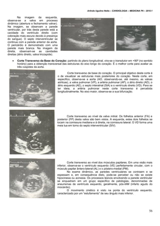 Arlindo Ugulino Netto – CARDIOLOGIA – MEDICINA P6 – 2010.1
56
Na imagem da esquerda,
observa-se a valva em processo
dinâmico (abertura e fechamento valvar).
Na imagem, se observam a parede
ventricular, por trás desta parede está a
cavidade do ventrículo direito (com
coloração mais escura devido à presença
do sangue). O septo interventricular se
continua com a parede anterior da aorta.
O pericárdio é demonstrado com uma
parede mais branca. Na imagem da
direita, observam-se as cavidades
direitas (átrio direito, valva tricúspide).
 Corte Transverso da Base do Coração: partindo do plano longitudinal, vira-se o transdutor em +90º (no sentido
horário) para a obtenção transversal das estruturas do eixo longo do coração. É o melhor corte para avaliar as
três cúspides da aorta.
Corte transverso de base do coração. O principal objetivo deste corte é
o de visualizar as estruturas mais posteriores do coração. Neste corte, em
especifico, observa-se a aorta (AO, observando-se, até mesmo, as valvas
aórticas), a valva pulmonar (VP), a artéria pulmonar (AP), o átrio direito (AD), o
átrio esquerdo (AE), o septo interatrial (SIA) e o ventrículo direito (VD). Para se
ter ideia, a artéria pulmonar neste corte transverso é percebida
longitudinalmente. No eixo maior, observa-se a sua bifurcação.
Corte transverso ao nível da valva mitral. Os folhetos anterior (FA) e
posterior (FP) desta valva são bem vistos. À esquerda, estes dois folhetos se
tocam na comissura mediana e à direita, na comissura lateral. O VD forma uma
meia lua em torno do septo interventricular (SIV).
Corte transverso ao nível dos músculos papilares. Em uma visão mais
inferior, observa-se o ventrículo esquerdo (VE) perfeitamente circular, com o
músculo papilar ântero-lateral (AL) e o póstero-medial (PM).
No exame dinâmico, as paredes ventriculares se contraem e se
espessam e, em consequência disto, pode-se perceber ou não se existe
hipocinesia ou acinesia. Os processos lesivos envolvendo a parede ventricular
se enquadram em um grupo especifico de patologias, denominadas de
aneurismas de ventrículo esquerdo, geralmente, pós-IAM (infarto agudo do
miocárdio).
O movimento cinético é visto na ponta do ventrículo esquerdo,
caracterizado por um “estufamento” de seu ângulo mais inferior.
 