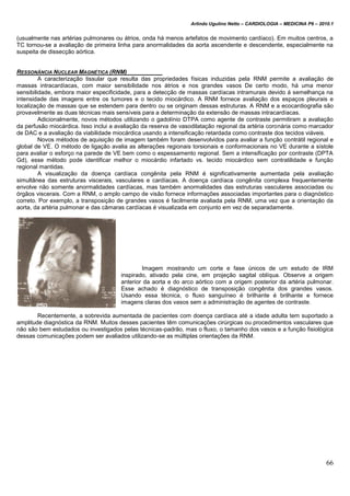 Arlindo Ugulino Netto – CARDIOLOGIA – MEDICINA P6 – 2010.1
66
(usualmente nas artérias pulmonares ou átrios, onda há menos artefatos de movimento cardíaco). Em muitos centros, a
TC tornou-se a avaliação de primeira linha para anormalidades da aorta ascendente e descendente, especialmente na
suspeita de dissecção aórtica.
RESSONÂNCIA NUCLEAR MAGNÉTICA (RNM)
A caracterização tissular que resulta das propriedades físicas induzidas pela RNM permite a avaliação de
massas intracardíacas, com maior sensibilidade nos átrios e nos grandes vasos De certo modo, há uma menor
sensibilidade, embora maior especificidade, para a detecção de massas cardíacas intramurais devido á semelhança na
intensidade das imagens entre os tumores e o tecido miocárdico. A RNM fornece avaliação dos espaços pleurais e
localização de massas que se estendem para dentro ou se originam dessas estruturas. A RNM e a ecocardiografia são
provavelmente as duas técnicas mais sensíveis para a determinação da extensão de massas intracardíacas.
Adicionalmente, novos métodos utilizando o gadolínio DTPA como agente de contraste permitiram a avaliação
da perfusão miocárdica. Isso inclui a avaliação da reserva de vasodilatação regional da artéria coronária como marcador
de DAC e a avaliação da viabilidade miocárdica usando a intensificação retardada como contraste dos tecidos viáveis.
Novos métodos de aquisição de imagem também foram desenvolvidos para avaliar a função contrátil regional e
global de VE. O método de ligação avalia as alterações regionais torsionais e conformacionais no VE durante a sístole
para avaliar o esforço na parede de VE bem como o espessamento regional. Sem a intensificação por contraste (DPTA
Gd), esse método pode identificar melhor o miocárdio infartado vs. tecido miocárdico sem contratilidade e função
regional mantidas.
A visualização da doença cardíaca congênita pela RNM é significativamente aumentada pela avaliação
simultânea das estruturas viscerais, vasculares e cardíacas. A doença cardíaca congênita complexa frequentemente
envolve não somente anormalidades cardíacas, mas também anormalidades das estruturas vasculares associadas ou
órgãos viscerais. Com a RNM, o amplo campo de visão fornece informações associadas importantes para o diagnóstico
correto. Por exemplo, a transposição de grandes vasos é facilmente avaliada pela RNM, uma vez que a orientação da
aorta, da artéria pulmonar e das câmaras cardíacas é visualizada em conjunto em vez de separadamente.
Imagem mostrando um corte e fase únicos de um estudo de IRM
inspirado, ativado pela cine, em projeção sagital oblíqua. Observe a origem
anterior da aorta e do arco aórtico com a origem posterior da artéria pulmonar.
Esse achado é diagnóstico de transposição congênita dos grandes vasos.
Usando essa técnica, o fluxo sanguíneo é brilhante é brilhante e fornece
imagens claras dos vasos sem a administração de agentes de contraste.
Recentemente, a sobrevida aumentada de pacientes com doença cardíaca até a idade adulta tem suportado a
amplitude diagnóstica da RNM. Muitos desses pacientes têm comunicações cirúrgicas ou procedimentos vasculares que
não são bem estudados ou investigados pelas técnicas-padrão, mas o fluxo, o tamanho dos vasos e a função fisiológica
dessas comunicações podem ser avaliados utilizando-se as múltiplas orientações da RNM.
 