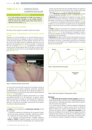 Manual A Mir www.academiamir.com 
2.1.- Pulso venoso yugular 
Del pulso venoso yugular se pueden obtener dos datos: 
Determinación semicuantitativa de la presión venosa 
central 
Equivale a la cifra de presión en la aurícula derecha que, en 
ausencia de estenosis tricuspídea, es igual a la presión diastóli-ca 
del ventrículo derecho. El límite superior normal es de 3 cm 
por encima del ángulo esternal, debiendo examinarse con el 
paciente semisentado con su tronco formando un ángulo de 
45º con la camilla (MIR 06, 24). Corresponde a una presión 
venosa central aproximada de 8-9 cm de agua, ya que la aurí-cula 
derecha se sitúa unos 5 cm por debajo del ángulo ester-nal 
(MIR 98F, 97). 
Ángulo de Louis 
5 cms. 
AD 
PVC 7 cms. H2O 
La causa más frecuente del aumento de la presión venosa es 
un aumento de la presión diastólica ventricular trasmitido 
retrógradamente, en situaciones de insuficiencia cardíaca. Se 
encontrará baja en situaciones de baja volemia (deshidratación 
(MIR 03, 97), hemorragia…). 
El reflujo hepatoyugular se explora presionando en la región 
periumbilical durante 10 a 30 segundos. La presión venosa 
yugular en personas normales no aumenta de forma significa-tiva, 
mientras que en personas con insuficiencia ventricular 
derecha o insuficiencia tricuspídea, aumenta de forma eviden-te 
y decae al dejar de presionar. 
Patrón de la onda venosa 
La onda a es el resultado de la contracción auricular al final 
de la diástole: 
- Cuando hay resistencia al llenado del VD aumenta la ampli-tud 
de esta onda: estenosis tricúspide, hipertensión pulmo-nar, 
hipertrofia ventricular derecha, estenosis pulmonar. 
- En el bloqueo aurículo-ventricular completo aparecen 
ondas a "cañón" irregulares porque la aurícula se contrae 
cuando el ventrículo esta contrayéndose. Es un signo de diso-ciación 
aurículo-ventricular que también aparece en presencia 
de ritmos de la unión aurículo-ventricular, siendo en este caso 
regulares (MIR 99, 25) y en la taquicadia ventricular. 
- En la fibrilación auricular la onda a desaparece, ya que 
no hay contracción auricular (MIR 01, 40; MIR 99F, 48). 
El descenso x es provocado por la relajación auricular, al prin-cipio 
de la contracción ventricular. Aumenta su amplitud en la 
pericarditis constrictiva y en el taponamiento cardíaco (MIR 00, 
97); disminuye en la dilatación del ventrículo derecho y puede 
invertirse en la insuficiencia tricúspide (el jet de regurgitación 
desde el ventrículo hacia la aurícula incrementa la presión en 
ésta). 
La onda v traduce el incremento en la presión auricular al lle-narse 
ésta desde las venas cavas; coincide con la sístole ventri-cular 
(MIR 03, 14). Si hay insuficiencia tricúspide la onda v 
aumenta (el llenado auricular se da desde dos fuentes: cavas y 
regurgitación ventriculoatrial). 
El descenso y se debe a la disminución de la presión en la aurí-cula 
derecha cuando se abre la válvula tricúspide y comienza el 
vaciamiento auricular. La pericarditis constrictiva se caracteriza 
por ondas x e y profundas, con un rápido ascenso: es un pulso 
venoso en forma de W. 
Diástole Sístole Diástole 
a x v y 
Taponamiento 
cardíaco 
a 
x 
v 
Patología 
1. La elevación de la presión venosa yugular aparece en: 
insuficiencia cardíaca, reducción en la distensibilidad del ven-trículo 
derecho, patología pericárdica, hipervolemia, obstruc-ción 
de la vena cava superior. 
2. En condiciones normales, la presión negativa intratorácica 
inspiratoria aumenta el retorno venoso hacia el ventrículo 
derecho (efecto de succión) disminuyendo la altura de la 
columna de presión venosa. El signo de Kussmaul es una 
elevación paradójica de la presión venosa yugular durante la 
inspiración que aparece en pacientes con dificultad para el 
llenado del ventrículo derecho: pericarditis constrictiva cróni-ca, 
insuficiencia cardíaca congestiva, estenosis tricuspídea... 
14 ] SEMIOLOGÍA CARDIOVASCULAR [ 
Figura 2. Ondas del pulso venoso yugular. 
Figura 3. Pulso venoso yugular en el taponamiento cardíaco. 
y 
TEMA 2 SEMIOLOGÍA 
CARDIOVASCULAR 
ENFOQUE MIR 
Es un tema bastante preguntado en el MIR, pero siempre se 
preguntan los mismos conceptos: es más rentable aprender 
estos de memoria que intentar razonar todos (sobre todo las 
alteraciones de las ondas x, y, v). 
Figura 1. Estimación de presión venosa central. 
 