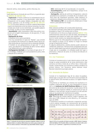 Manual A Mir www.academiamir.com 
disección aórtica, rotura aórtica, aortitis infecciosa, etc. 
Diagnóstico 
Suele detectarse en el estudio de una HTA en un paciente adul-to 
(MIR 00, 99; MIR 98, 124). 
- Exploración: el hecho cardinal es la comprobación de pul-sos 
femorales ausentes o muy disminuidos, sobre todo en 
comparación con los pulsos radiales o braquiales (con dife-rencias 
superiores a los 20 mmHg) (MIR 06, 26; MIR 97F, 
254). Es muy típico observar circulación colateral desarrollada 
a partir de anastomosis entre las arterias mamarias y las inter-costales 
para eludir la zona estrechada, que pueden palparse 
en el tórax, la axila y la zona interescapular. 
- Auscultación: soplo mesosistólico sobre área aórtica (con-tinuo) 
y en la región interescapular, clic de eyección, 2º ruido 
fuerte, 4º ruido. 
- Radiografía de tórax: 
• Dilatación de la aorta ascendente. 
• Es muy característico el signo de "Roesler", que consiste 
en la presencia de muescas en el reborde inferior de las cos-tillas 
producidas por la protusión de las colaterales dilatadas. 
• También es casi patognomónico el signo del "3" en la 
aorta, que adquiere la morfología de dicho número debido 
a las dilataciones pre y post-coartación. 
- Esofagograma baritado: es muy típico el signo de la "E" 
en el esófago, moldeado por la tortuosidad de la aorta, antes 
y después de la estrechez. 
- ECG: sobrecarga del VI con eje desviado a la izquierda. 
- Ecocardiograma: puede dar el diagnóstico, aunque no es 
la técnica de elección. 
- Aortografía: además de confirmar el diagnóstico, valora la 
gravedad de la coartación y el estado de la circulación cola-teral 
antes del tratamiento quirúrgico. Debe realizarce un 
cateterismo obligado de las arterias coronarias en el adulto. 
- TAC torácico y RM: son pruebas de utilidad para el diag-nóstico 
y para planificar la cirugía. 
Tratamiento 
Debe realizarse profilaxis de la endocarditis bacteriana. 
La indicación quirúrgica viene dada por el gradiente de presión 
brazo/pierna mayor a 20 mmHg y por la clínica. 
El tratamiento en el niño es la cirugía correctora (MIR 07, 191), 
preferentemente antes de los 6 años de edad, reservándose la 
angioplastia percutánea con balón para aquellos casos urgen-tes 
en el recién nacido y las reestenosis postcirugía. 
Mientras que en los niños pequeños la incidencia de hiperten-sión 
residual es escasa, en los adultos la cirugía no siempre 
corrige la hipertensión arterial. 
En algunos adolescentes y adultos jóvenes puede valorarse la 
utilidad del cateterismo intervencionista (angioplastia percutá-nea 
con catéter-balón) que evita la complicación principal de la 
cirugía que es la paraplejía; sin embargo puede dar lugar a 
aneurismas o disección de aorta. Es la técnica de elección en 
las reestenosis. 
5.5.- Cor Triatriatum 
Consiste en la existencia de un vaso colector previo a la AI, que 
recoge la sangre procedente de las venas pulmonares y que 
comunica con ésta a través de un orificio más o menos este-nosado, 
condicionando una insuficiencia cardíaca variable en la 
primera infancia. Con frecuencia, asocia estenosis mitral. 
Necesita tratamiento quirúrgico precoz. 
5.6.- Anomalía de Ebstein 
Consiste en la implantación baja de las valvas tricuspídeas, 
dando lugar a una gran AD. Con frecuencia asocia prolapso de 
la válvula mitral. Esta anomalía se asocia a la ingesta materna 
de litio. 
Clínicamente se manifiesta con síntomas de insuficiencia tri-cuspídea 
y disfunción del VD. Es muy característica la asocia-ción 
a un síndrome de Wolff-Parkinson-White por la exis-tencia 
de vías de conducción accesorias. Cuando asocia CIA da 
lugar a cianosis progresiva debido al cortocircuito D-I que se 
establece a nivel auricular, ya que la presión en la AD está ele-vada 
por la presencia de insuficiencia tricuspídea. 
Radiografía de tórax: cardiomegalia por aumento de la AD. 
ECG: sobrecarga de corazón derecho; ondas P gigantes, más 
altas que el QRS, bloqueo de rama derecha y, en ocasiones, 
signo de WPW. 
El tratamiento consiste en la sustitución o reparación quirúrgi-ca 
de la válvula tricúspide, con reconstrucción de la porción 
atrializada del VD y, cuando sea necesario, ablación de las vías 
accesorias. 
Figura 6. Muescas costales en la coartación de aorta. 
Figura 7. Coartación de aorta vista por resonancia magnética. Nótese la zona de 
coartación distal a la subclavia (flecha blanca) así como la gran circulación cola-teral 
con arterias mamarias e intercostales muy desarrolladas (flechas negras). 
40 ] CARDIOPATÍAS CONGÉNITAS [ 
Figura 8. ECG en la anomalía de Ebstein asociado a WPW. Nótese el empasta-miento 
del QRS en V5-V6 (ondas delta) y la presencia de ondas P altas y picu-das 
en II y V1("P pulmonar") sugerentes de crecimiento de la AD. 
 