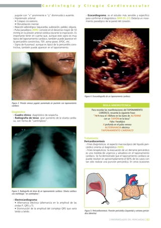 C a r d i o l o g í a y C i r u g í a C a r d i o v a s c u l a r 
yugular con "x" prominente e "y" disminuida o ausente. 
- Hipotensión arterial: 
• Colapso circulatorio. 
• Obnubilación mental. 
- Reacción adrenérgica: taquicardia, sudoración, palidez, oliguria. 
- Pulso paradójico (MIR): consiste en el descenso mayor de 10 
mmHg en la presión arterial sistólica durante la inspiración. Es 
importante tener en cuenta que, aunque este signo es muy 
típico del taponamiento cardíaco, también puede aparecer en 
la pericarditis constrictiva, TEP, asma grave, EPOC, etc. 
- Signo de Kussmaul: aunque es típico de la pericarditis cons-trictiva, 
también puede aparecer en el taponamiento. 
Diagnóstico 
- Cuadro clínico: diagnóstico de sospecha. 
- Radiografía de tórax: gran aumento de la silueta cardía-ca, 
con forma de "cantimplora". 
- Electrocardiograma: 
• Alternancia eléctrica (alternancia en la amplitud de las 
ondas P, QRS y T). 
• Disminución de la amplitud del complejo QRS que varía 
latido a latido. 
- Ecocardiograma: es el estudio más sensible y específico 
para confirmar el diagnóstico (MIR 05, 27). Detecta un movi-miento 
paradójico de la pared del corazón. 
AD 
Ao 
VI 
VD 
REGLA MNEMOTÉCNICA 
Pericardio 
Tratamiento 
Pericardiocentesis 
- Fines diagnósticos: el aspecto macroscópico del líquido peri-cárdico 
orienta al diagnóstico (MIR). 
- Fines terapéuticos: la evacuación de un derrame pericárdico 
es una medida de urgencia y salvadora en el taponamiento 
cardíaco. Se ha demostrado que el taponamiento cardíaco se 
puede resolver en aproximadamente el 60% de los casos con 
tan sólo realizar una punción pericárdica. En otras ocasiones 
] ENFERMEDADES DEL PERICARDIO [ 83 
Figura 2. Presión venosa yugular aumentada en paciente con taponamiento 
cardíaco. 
Para recordar las manifestaciones del TAPONAMIENTO 
CARDÍACO, recuerda la siguiente frase: 
"PePe toca el Xilófono en los bares de ALTERNE 
con un TAPÓN en la boca" 
Pulso Paradójico 
X profunda en el pulso venoso 
ALTERNANCIA eléctrica 
TAPONAMIENTO CARDÍACO 
Figura 3. Radiografía de tórax de un taponamiento cardíaco. Silueta cardíaca 
con morfología "en cantimplora". 
Figura 4. Ecocardiografía de un taponamiento cardíaco. 
Figura 5. Pericardiocentesis. Punción pericárdica (izquierda) y ventana pericár-dica 
(derecha). 
 