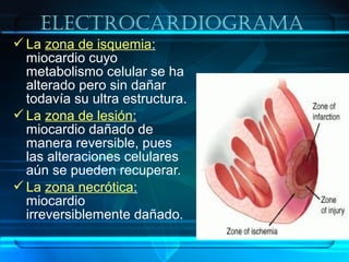 La zona de isquemia:
miocardio cuyo
metabolismo celular se ha
alterado pero sin dañar
todavía su ultra estructura.
La zona de lesión:
miocardio dañado de
manera reversible, pues
las alteraciones celulares
aún se pueden recuperar.
La zona necrótica:
miocardio
irreversiblemente dañado.
ElEctrocardiograma
 